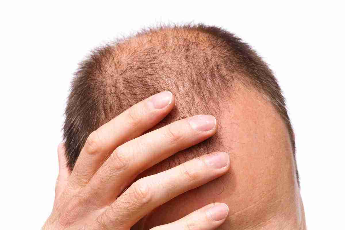 عوارض کاشت مو و راه های جلوگیری از آن